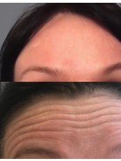 Treatment for Wrinkles - CB Skin And Aesthetics Illkeston
