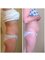 The Eden Clinic - 3D-Lipo treatment, before & after 