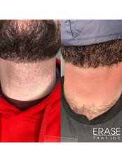Laser Hair Removal - Erase that Ink