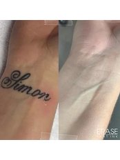 Tattoo Removal - Erase that Ink