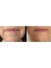 Down-Turned Mouth Corners - Dr Cei Aesthetics