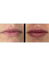 Lip Filler - Dr Cei Aesthetics
