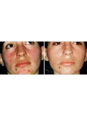 Acne Treatment - Sandon Court Clinic Plymouth