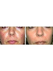IPL Skin Rejuvenation Full Face - Sandon Court Clinic Plymouth