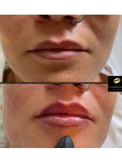 Lip Augmentation - Elle Medical Cosmetics