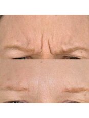 Treatment for Wrinkles - Elle Medical Cosmetics