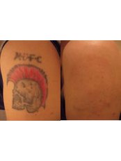 Tattoo Removal - Laser Skin Solutions