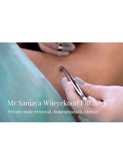 Mole Removal  - Mr Sanjaya WIjeyekoon Private General Surgeon