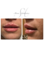 Lip Augmentation - Shore Aesthetics