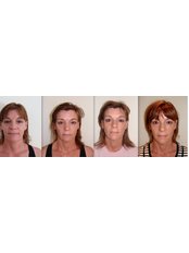 Non-Surgical Facelift - The Green Room - Bournemouth Clinic
