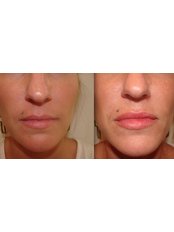 Lip Augmentation - The Green Room - Bournemouth Clinic