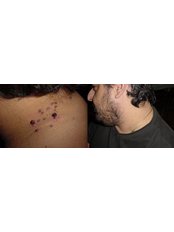 Skin Tag Removal - The Green Room - Bournemouth Clinic