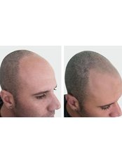 Scalp Micropigmentation - Tattoo Hairlines Scalp Micropigmentation (SMP)