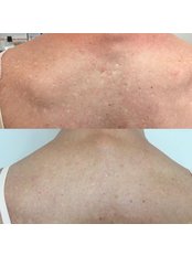Acne Scars Treatment - Skin.ID
