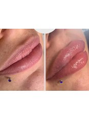 Lip Augmentation - Nueva Aesthetics