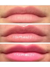 Lip Augmentation - Natural Radiance Skin Rejuvenation Clinic