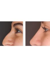 Non-Surgical Nose Job - Facial Cosmetics
