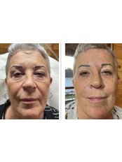 Skin Booster - Facial Cosmetics