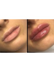 Lip Filler - Facial Cosmetics