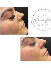 Non-Surgical Nose Job - The Wrinkle Room