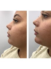 Chin Augmentation - The Wrinkle Room