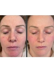 Apollo Duet Facial (50 mins) - Suzanne Haughey Therapies