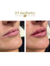 Lip Augmentation - LH Aesthetics