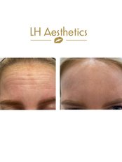 Wrinkle relaxing treatments 3 areas - LH Aesthetics