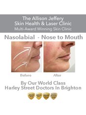 Dermal Fillers - Nasolabial  (Nose to Mouth lines)  - Allison Jeffery Skin Health and Laser Clinic