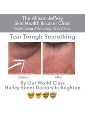 Dermal Fillers - Tear Troughs | Was £399 - Now £299 by World Expert Dr Rami - Allison Jeffery Skin Health and Laser Clinic
