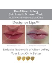 Designer Lips ™ - Advanced & Exclusive (0.5ml Syringe) £199 for limited time only | £225 on Saturday - Allison Jeffery Skin Health and Laser Clinic