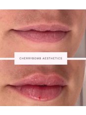 Lip Augmentation - CherryBomb Aesthetics