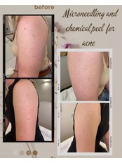Acne /Scars /  Fine lines Treatment - Dermal Enhance - Brighton