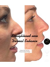 Non-Surgical Nose Job ( Nose straightening) - Dermal Enhance - Brighton