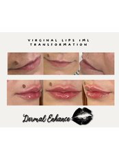 Lip Augmentation1ml - Dermal Enhance - Eastbourne