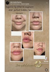 Lip Augmentation1ml - Dermal Enhance - Eastbourne