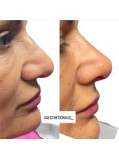Non-Surgical Nose Job ( Nose straightening) - Dermal Enhance - Eastbourne