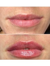 Lip Augmentation - L1P Aesthetics