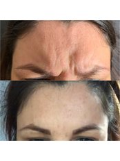 Anti Wrinkle Injections - L1P Aesthetics