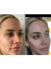 Dermal Fillers - Aesthetics by Victoria