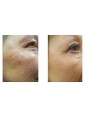 crows feet treatment . Fantastic result after 2 weeks - Aesthetics by Victoria