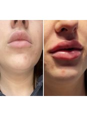 Lip Augmentation - Aesthetics for essex