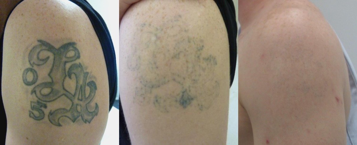 The Tattoo Removal Clinic in Chelmsford • Read 1 Review