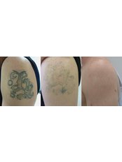 Tattoo Removal - The Tattoo Removal Clinic