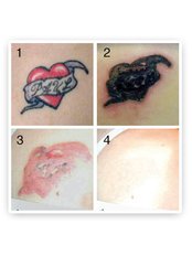 Tattoo Removal - Wellness Clinic