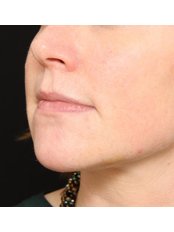 Dermal Fillers - Time Clinic