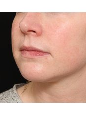 Dermal Fillers - Time Clinic