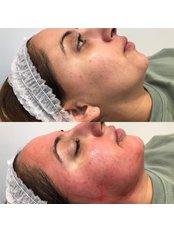 Microneedling - Epping Beauty Clinic