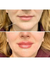 Dermal Fillers - Epping Beauty Clinic