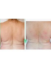 Fat Reduction Injections - Epping Beauty Clinic